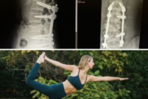 <strong>Emily Hamilton had eight screws and two rods inserted during spinal surgery. She&rsquo;s now an instructor at Sana Yoga.</strong> (From top to bottom: Courtesy Emily Hamilton; Courtesy Bethany Reid)