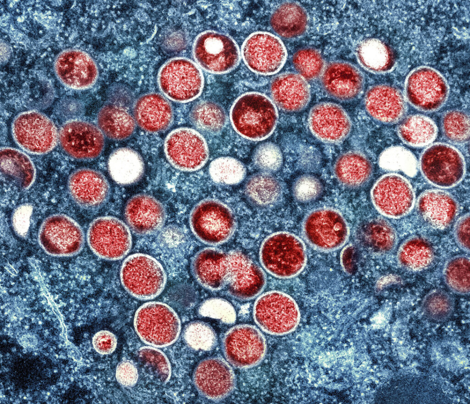 <strong>This image provided by the National Institute of Allergy and Infectious Diseases (NIAID) shows a colorized transmission electron micrograph of monkeypox particles (red) found within an infected cell (blue), cultured in the laboratory that was captured and color-enhanced at the NIAID Integrated Research Facility (IRF) in Fort Detrick, Maryland.</strong> (NIAID via AP)
